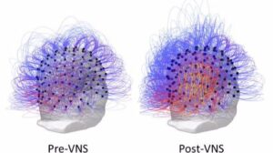 Flujo de información a través de los electrodos antes y después de la estimulación del nervio vago (a la derecha, post-VNS). A la derecha, los colores cálidos (amarillo y rojo) indican un aumento en la conectividad entre las regiones parietales posteriore