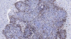 Tumor metastásico de colon infiltrado por el sistema inmune (en marrón) tras la combinación del inhibidor de TGF-beta e inmunoterapia