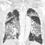 Imagen de los pulmones del paciente que rechazó la vacuna del coronavirus