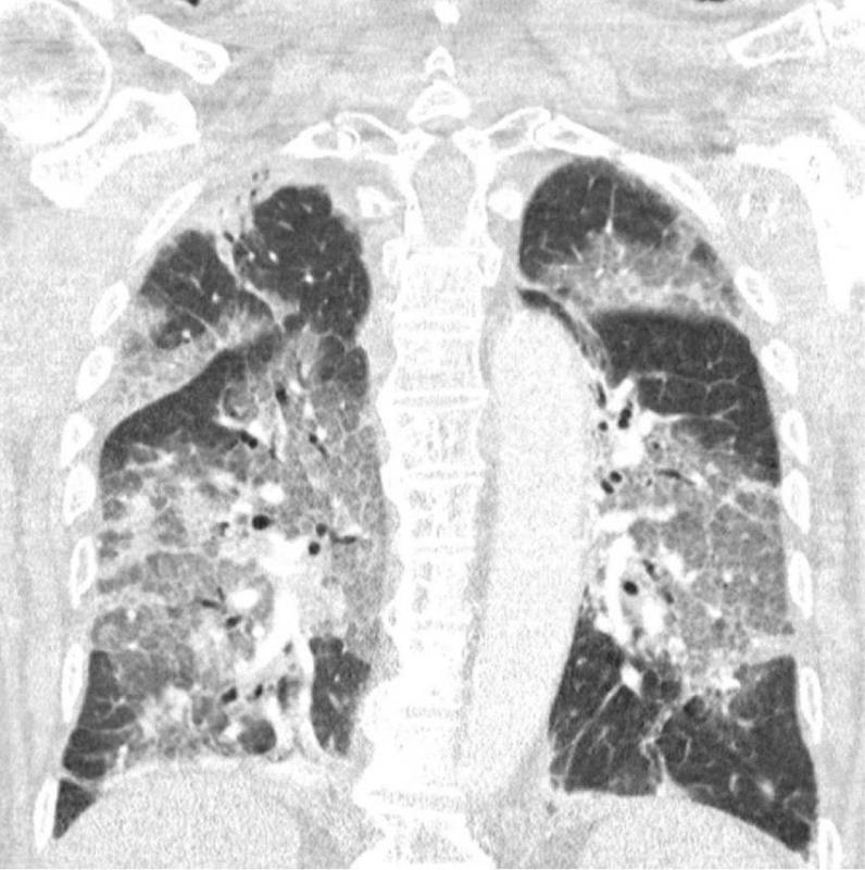 Imagen de los pulmones del paciente que rechazó la vacuna del coronavirus