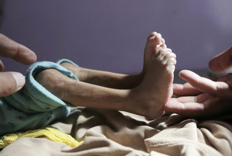 Imagen de archivo de un niño con desnutrición en un hospital en Yemen (Foto: Europa Press/Contacto/Mohammed Mohammed)
