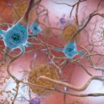En el cerebro afectado por alzhéimer se observan placas beta amiloides entre las neuronas (marrón) y ovillos de proteína tau dentro de las neuronas (azul) que tradicionalmente se han debatido como causas de la enfermedad. Hoy se sugiere que la raíz podría ser otra. / NIH