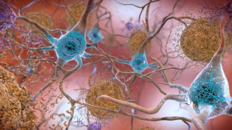En el cerebro afectado por alzhéimer se observan placas beta amiloides entre las neuronas (marrón) y ovillos de proteína tau dentro de las neuronas (azul) que tradicionalmente se han debatido como causas de la enfermedad. Hoy se sugiere que la raíz podría ser otra. / NIH